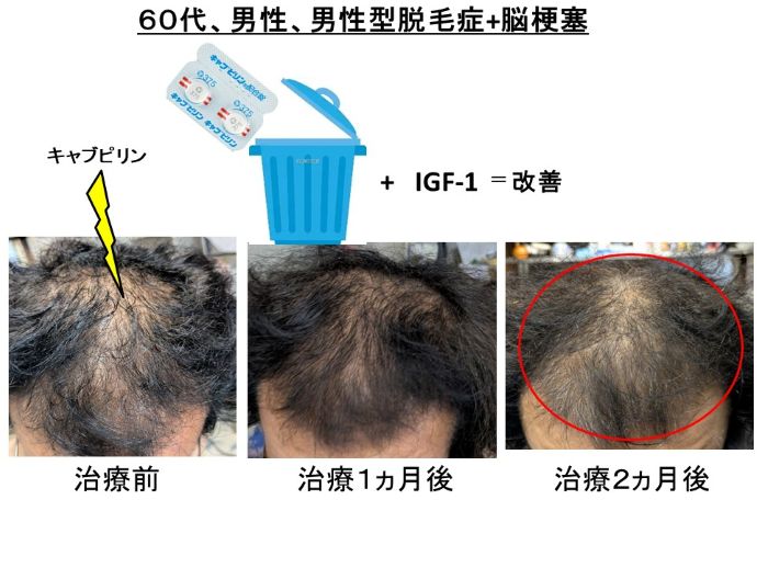 円形脱毛症　病院